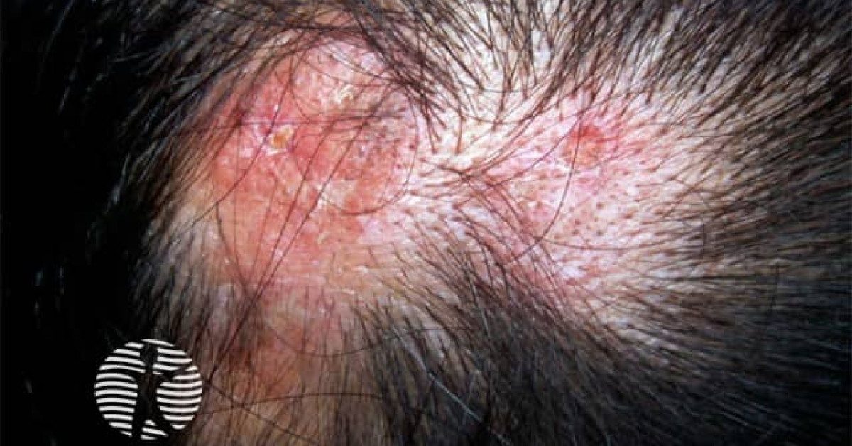 Discoid lupus erythematosus image