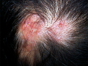 Cutaneous Lupus Erythematosus Dermnet Nz