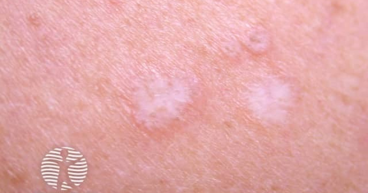 extragenital-lichen-sclerosus-image