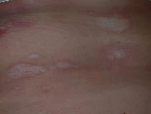 Extragenital lichen sclerosus