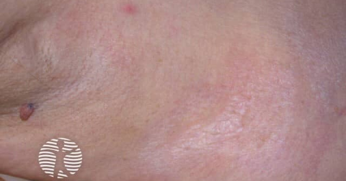 Extragenital Lichen Sclerosus Image lichen-planus-purple-skin-lesions-causes-signs-46-off