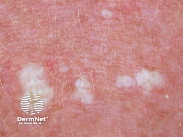 Vulval Lichen Sclerosus Images Dermnet Nz Lichen Sclerosus DermNet