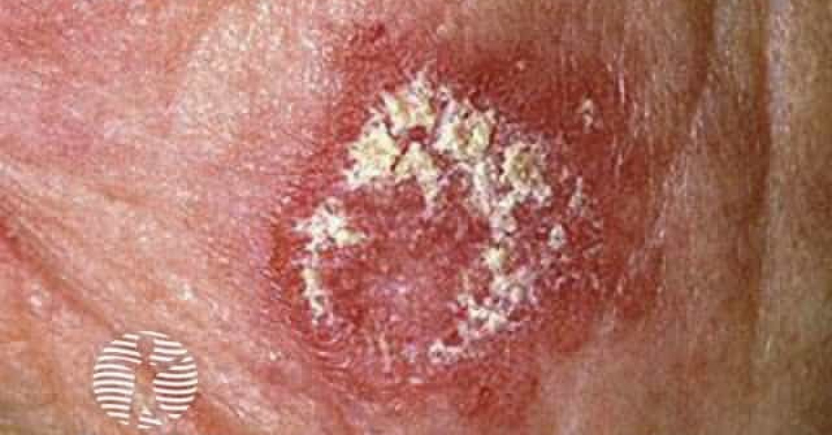 Cutaneous lupus erythematosus image