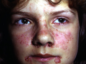 Lupus erythematosus images | DermNet