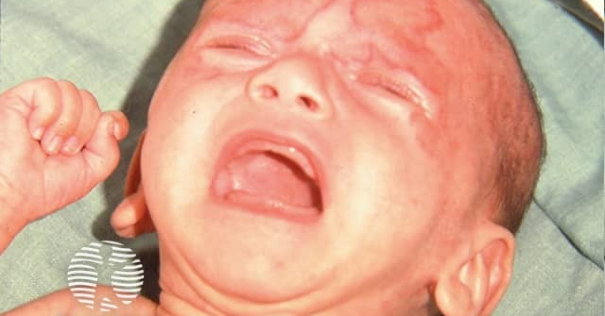 Neonatal lupus image Neonatal lupus image