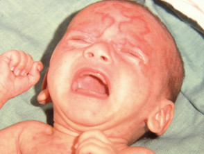 Neonatal lupus