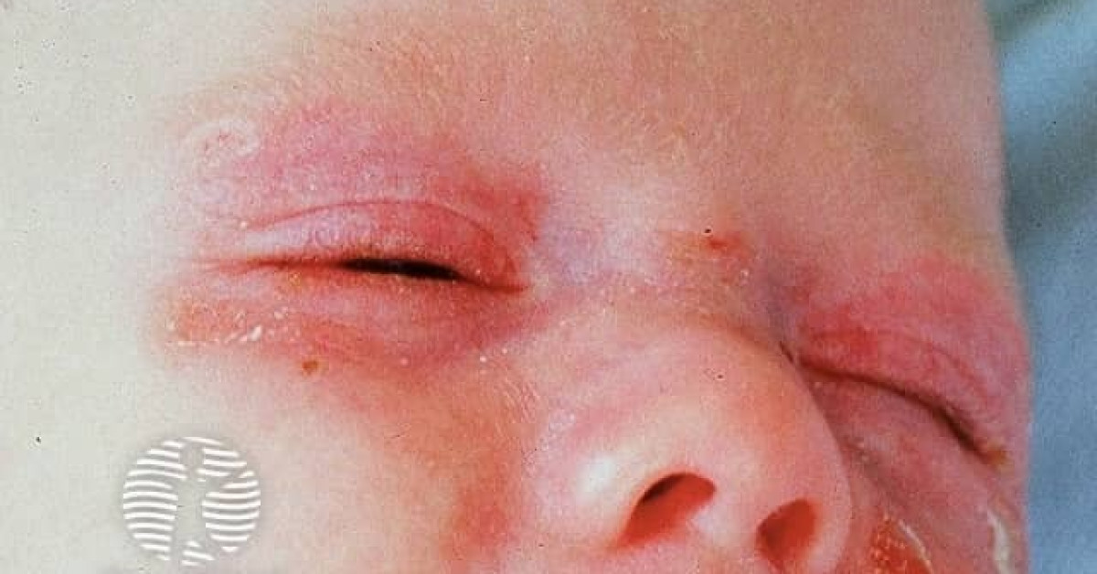 Neonatal lupus image