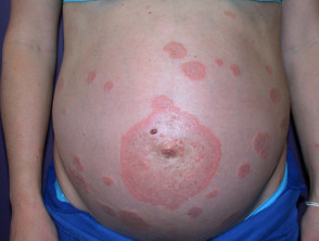 Pemphigoid gestationis