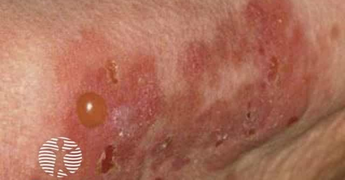 Pemphoid Rash Legs Bullous pemphigoid image