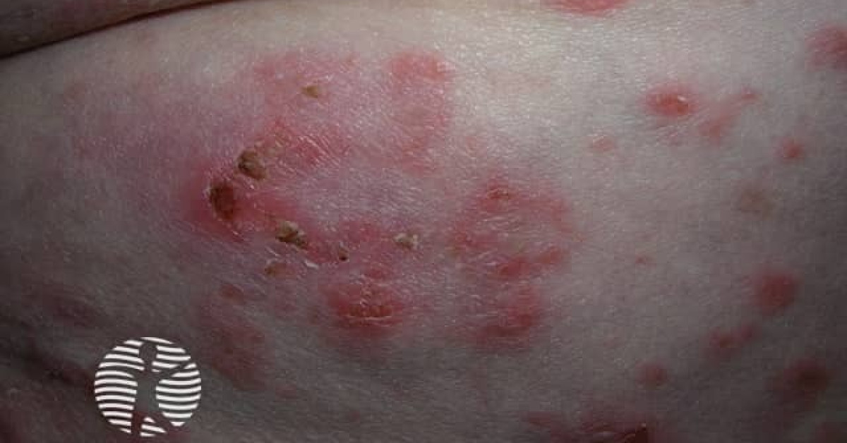 Pemphoid Rash Legs Bullous pemphigoid image