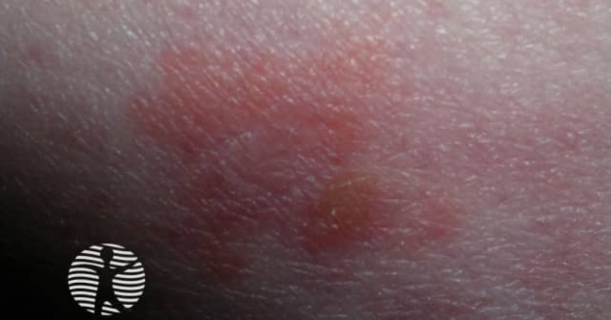 Bullous pemphigoid image