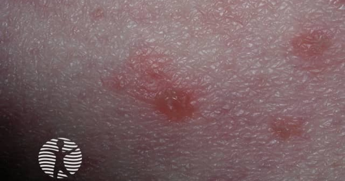 Bullous pemphigoid image