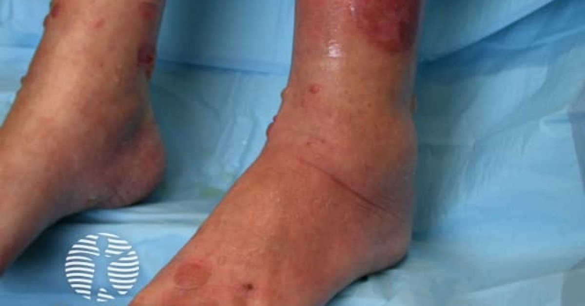 Pemphoid Rash Legs Bullous pemphigoid image