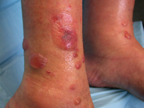 Bullous pemphigoid blisters - Stock Image - C055/9327 - Science Photo  Library
