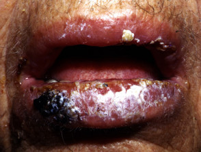 Oral pemphigus vulgaris