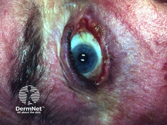 Ocular pemphigus vulgaris