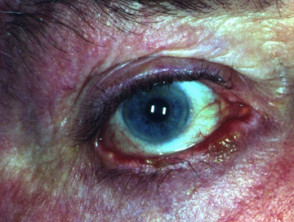 Ocular pemphigus vulgaris