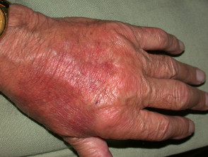 Neutrophilic dermatosis associated with rheumatoid arthritis