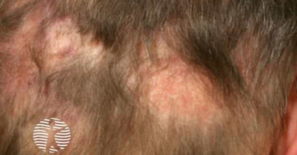 Discoid lupus erythematosus image