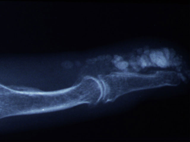 X-ray of calcinosis
