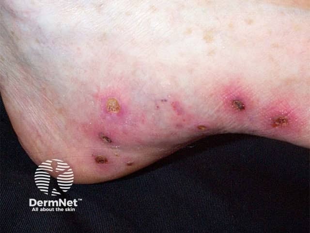 Ulcers on foot