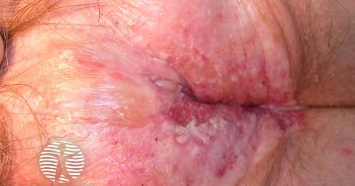 Wie Sieht Lichen Sclerosus In Der Scheide Aus dermnetnz.org