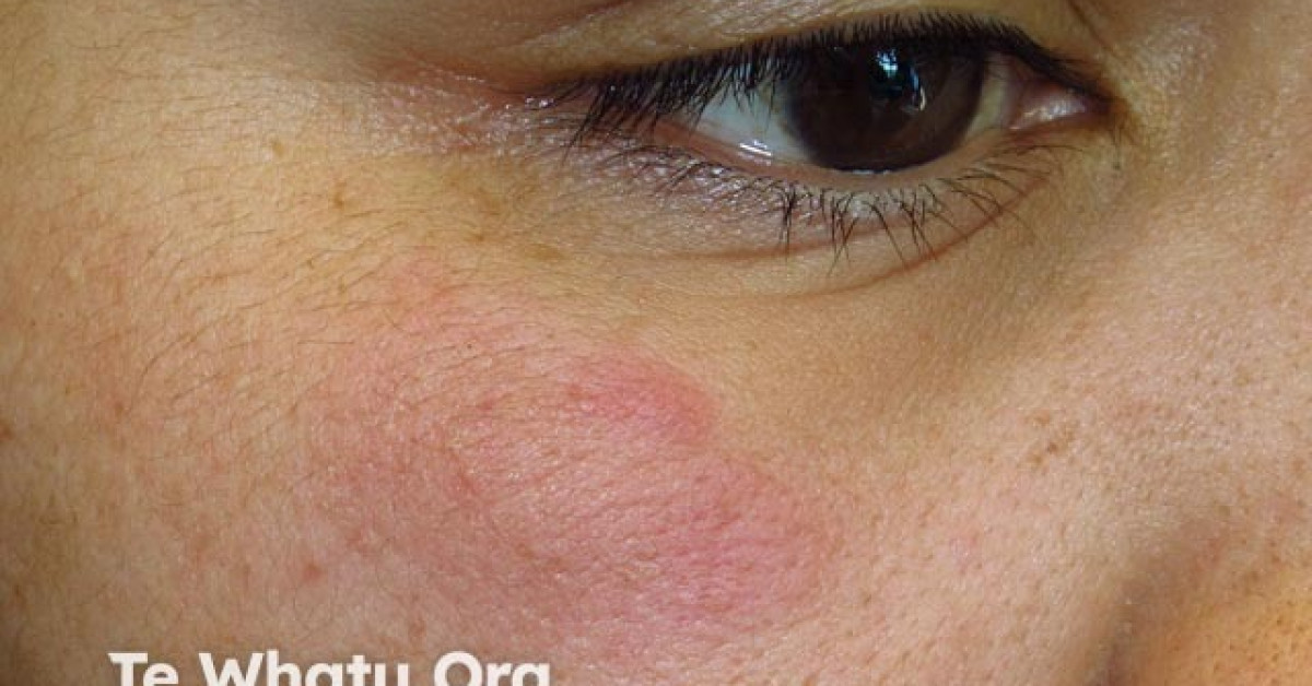 Chronic tumid lupus erythematosus image