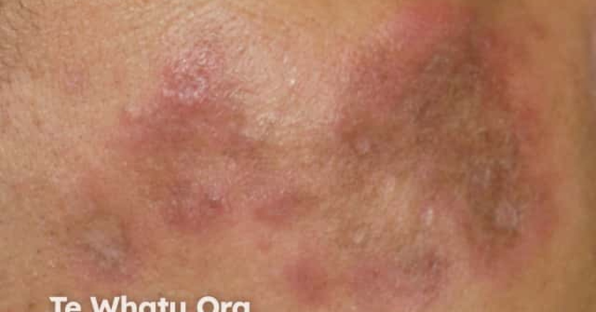 Dermnet chronic discoid lupus erythematosus image