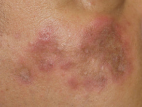mild discoid rash