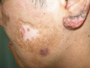 Cutaneous lupus erythematosus | DermNet
