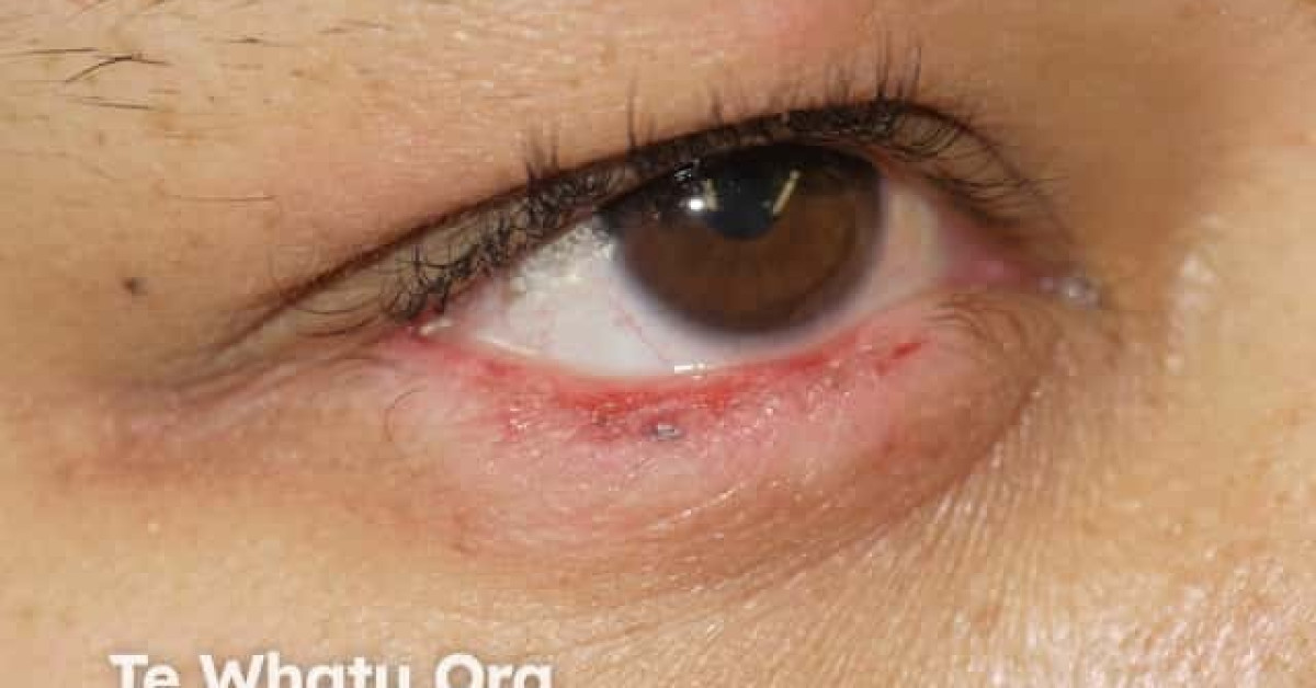 Chronic Discoid Lupus