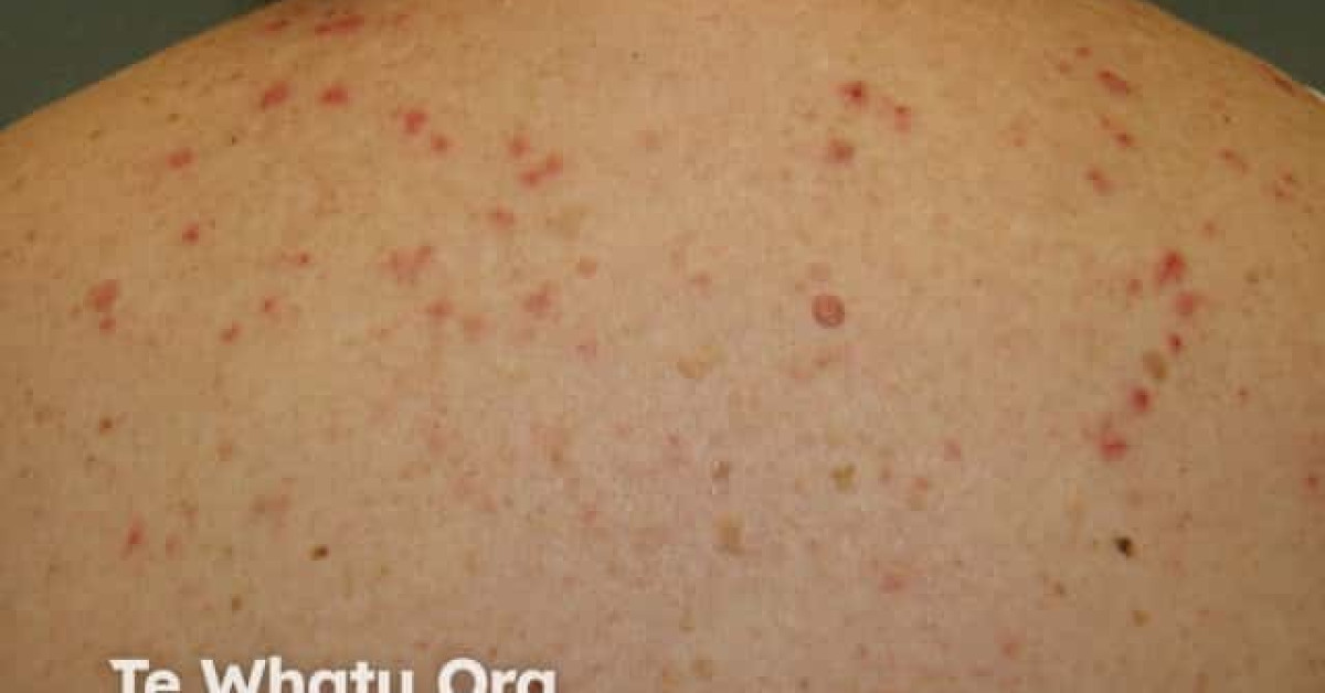 Dermatitis induced by immunoglobulin injections image