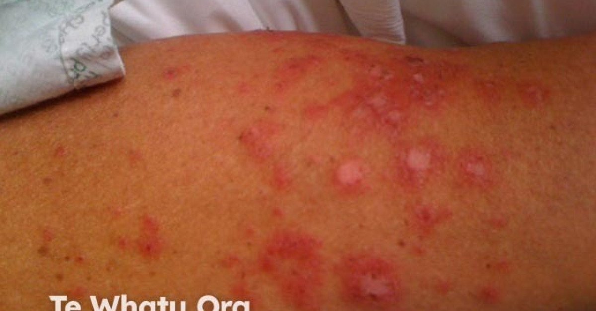 Systemic lupus erythematosus image