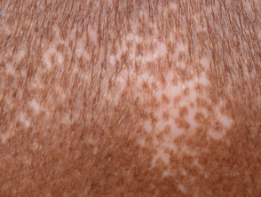Systemic sclerosis salt and pepper pigmentation