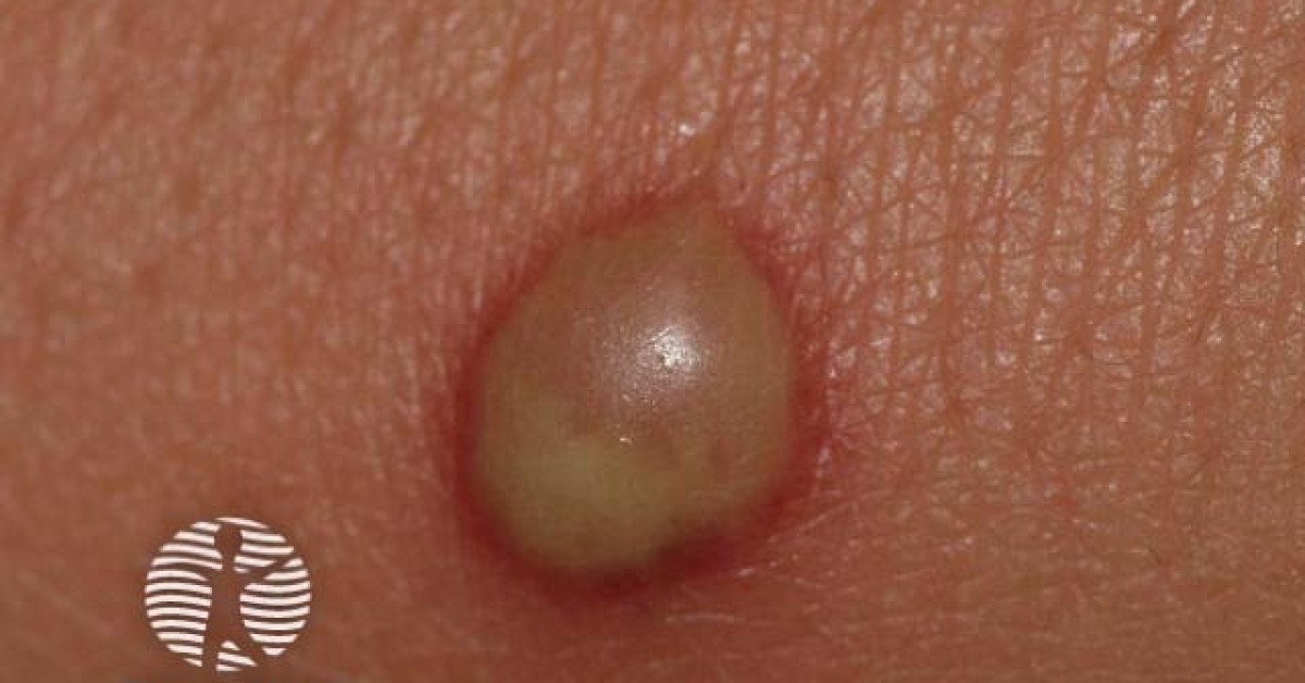 Pustule in bullous impetigo image
