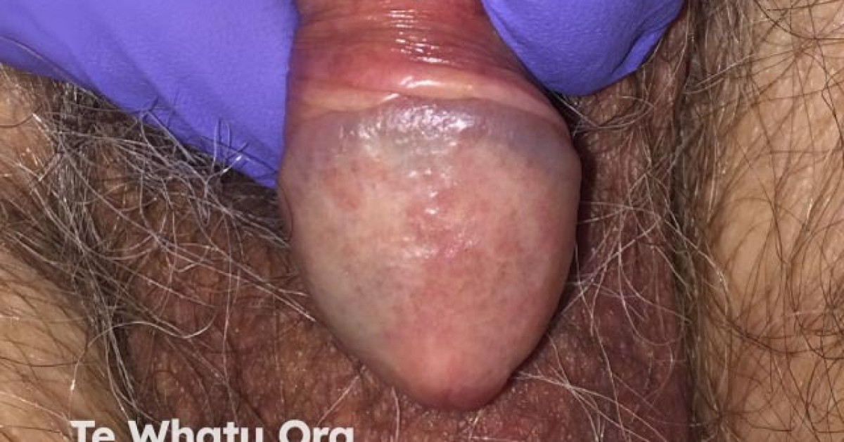Pee Rash Incontinence dermatitis image