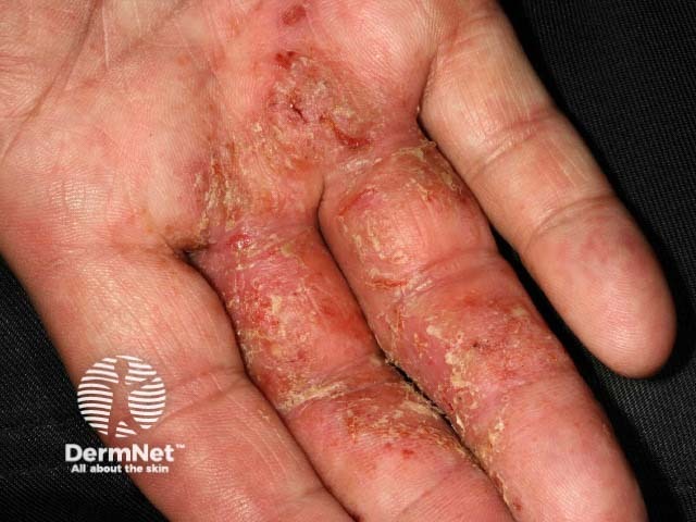 Infected hand dermatitis
