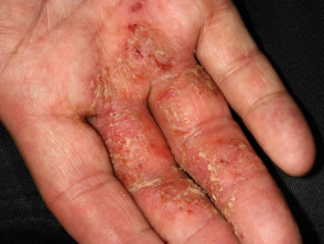 Infected vesicular hand dermatitis