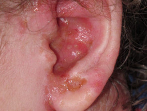Infected eczema