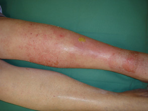 Infected venous ulcer