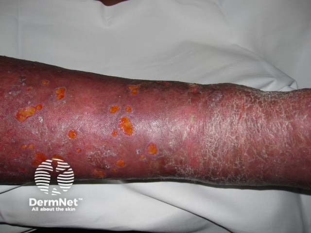 Cellulitis and venous insufficiency