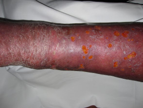 Cellulitis and venous insufficiency