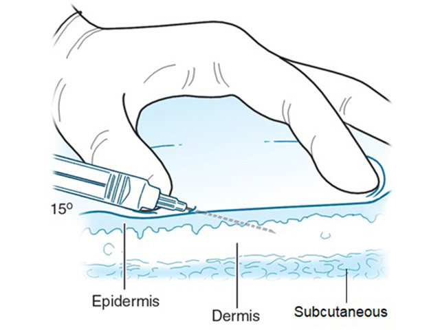 Figure 2: injecting into the superficial dermis
