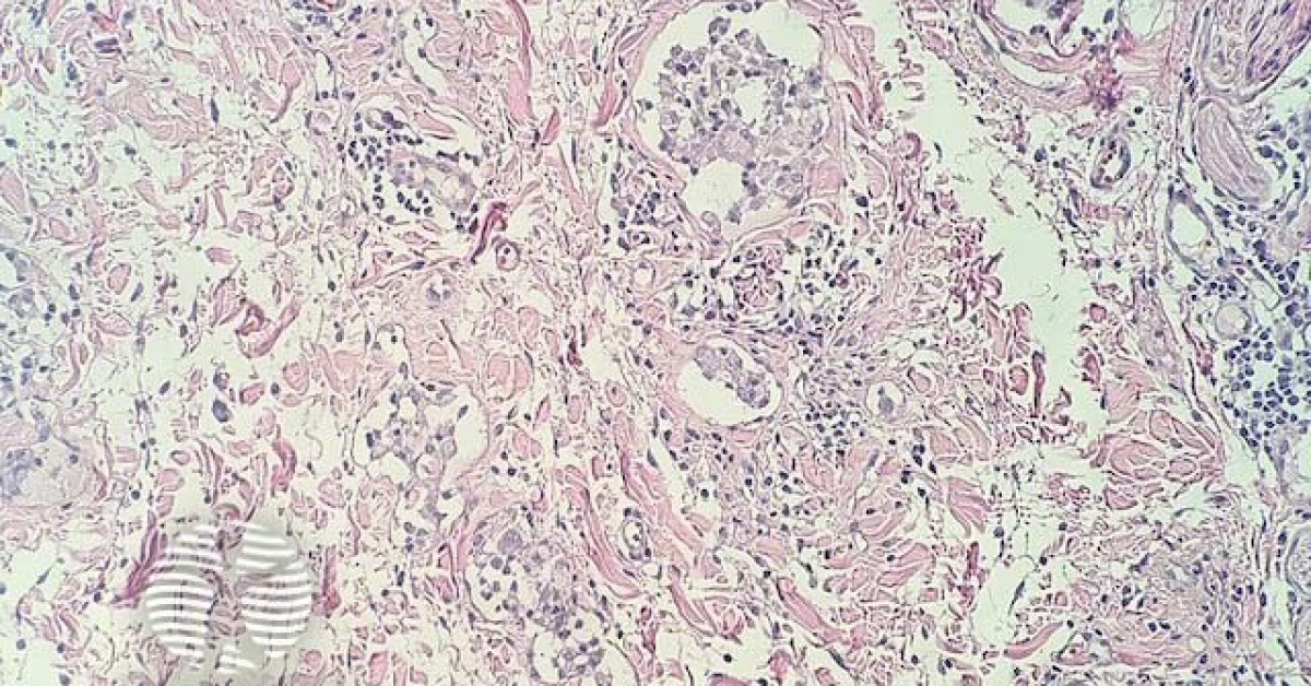 DermNet® - Intralymphatic histiocytosis pathology image
