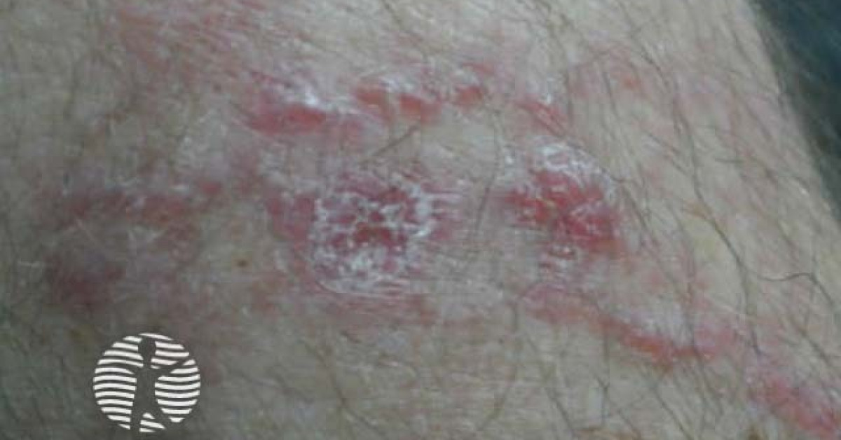 Intralymphatic histiocytosis image