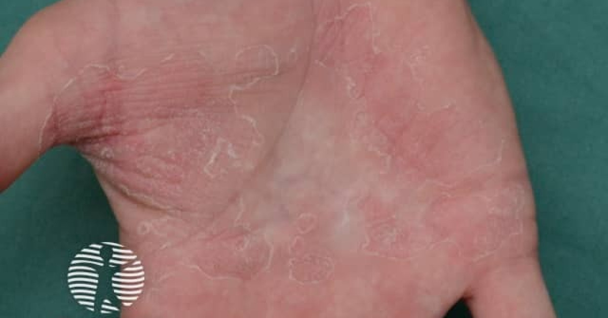 Irritant contact hand dermatitis image