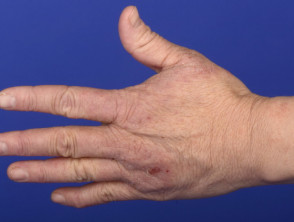 Irritant contact hand dermatitis