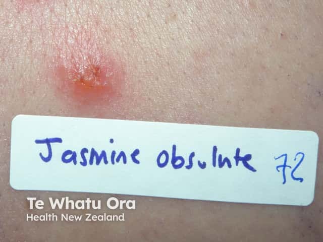 Positive patch tests to jasmine absolute oil