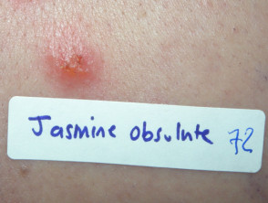 Positive patch tests to jasmine absolute oil
