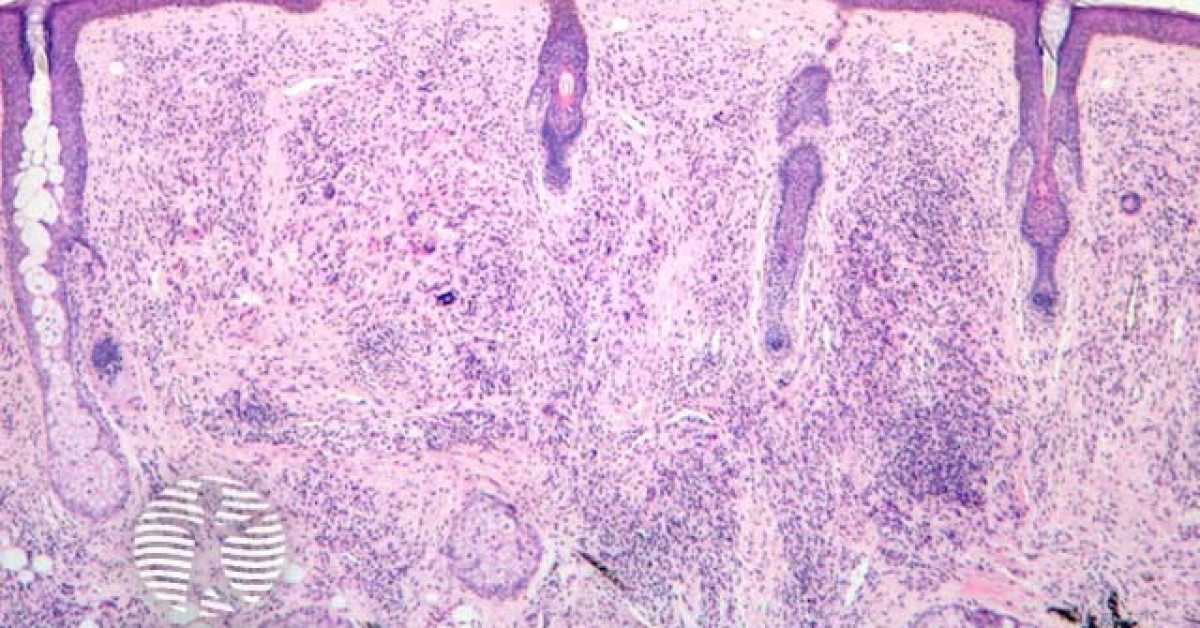 Juvenile xanthogranuloma image